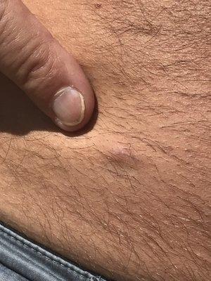 left abdominal incision 23 days after surgery