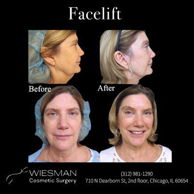 Facelift by Dr. Irvin Wiesman. Please call (312) 981-1290 to schedule your appointment!