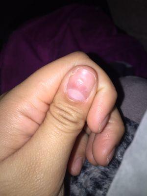 YOU CAN SEE THE NAIL BED SPLIT AND IM MISSING A PART OF MY NAIL