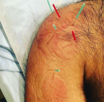 Acupuncture and Cupping