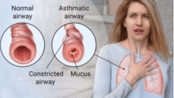 Diagnosing and treating asthma