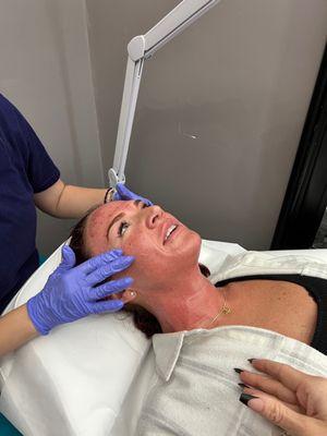 Morpheous8 treatment