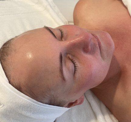 Post Dermaplaning and Nano Infusion Treatments