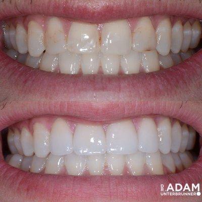 This patient had congenital malformations that Dr. Adam Unterbrunner corrected for a wonderful result with veneers and whitening.