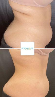 EmsculptNEO transformation at Renewlogie. Patient completed a series of 6.