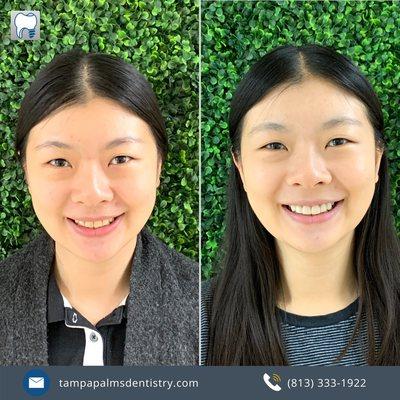 Patient wanted to restore her smile back to harmony! Porcelain veneers used and patient was extremely satisfied!