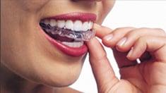 Invisalign invisibly straightens your teeth with a series of custom-molded aligners.