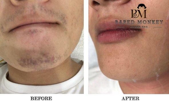 Men's facial hair removal