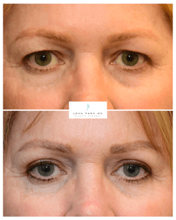 Bilateral Upper Eyelid Blepharoplasty, Lateral Brow Lift