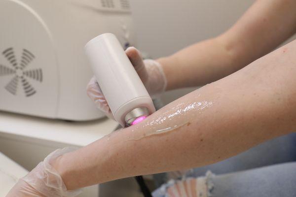 Painless Laser Hair Removal