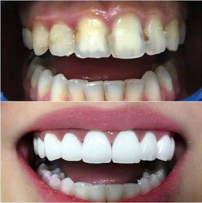 Before and after at NÜVA Smile | Teaneck, NJ