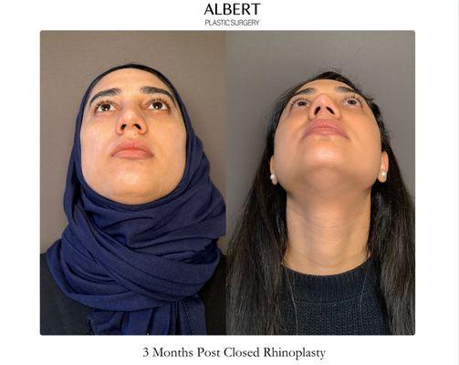 Closed (Scarless) Rhinoplasty