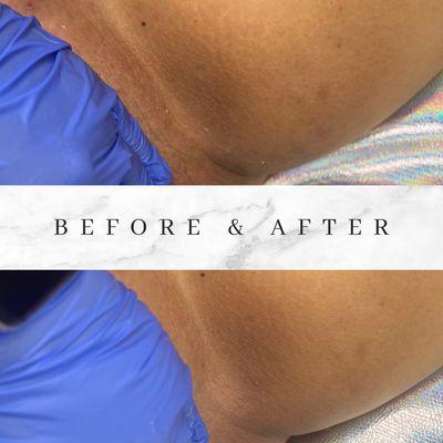 Intimate area brightening after one treatment