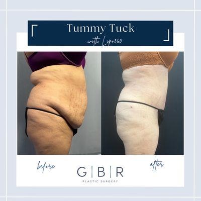 Tummy Tuck with Liposuction Virginia beach