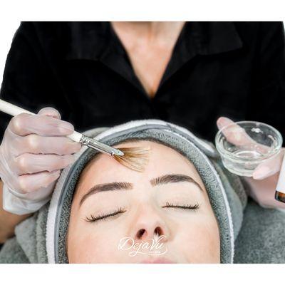 Customized Chemical Peels