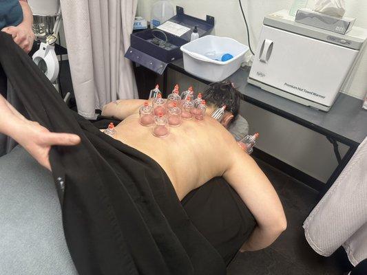 Cupping