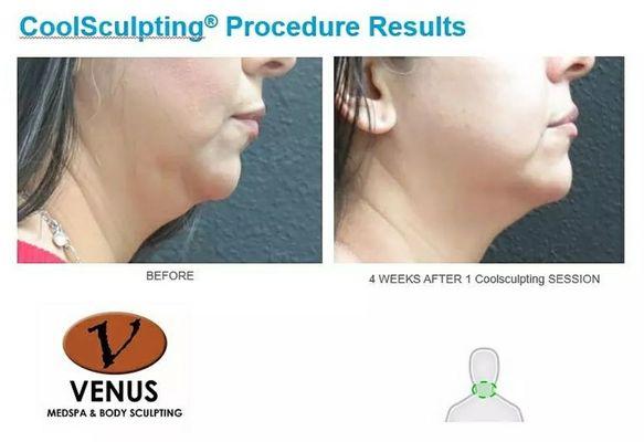 Improve your profile with Coolsculpting. NO surgery NO needles NO downtime.