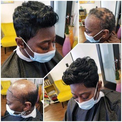 Non-surgical hair replacement (custom topper)