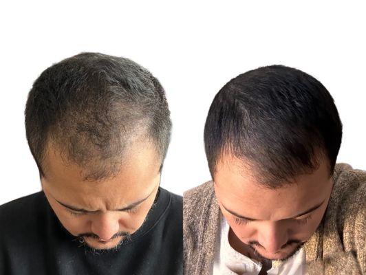 Scalp Micropigmentation for density