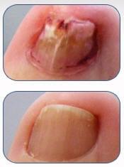 Before and After Laser Solution