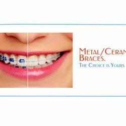 Metal & Ceramic Braces Avalilable