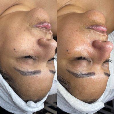 Making progress on your skin, one treatment at a time. Treatment: Galactic Glow w/Dermaplaning. Goodbye dull skin!