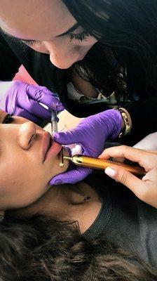 Dermal Fillers to add volume to lips