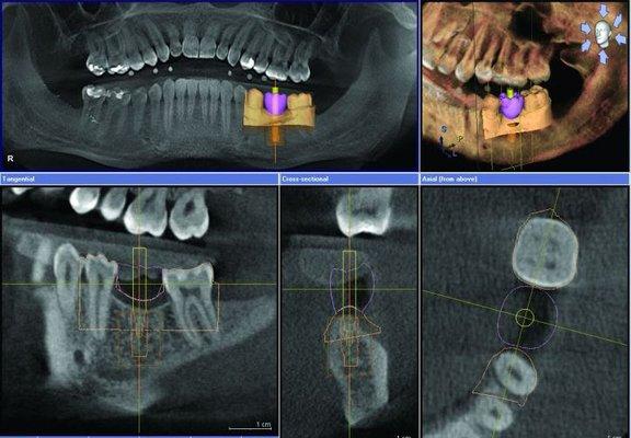 Our implant design software screen shot