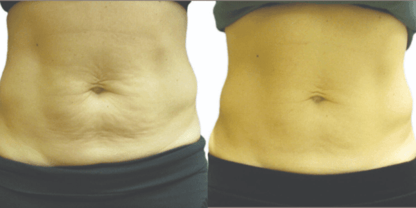 Body Contouring Before and After.