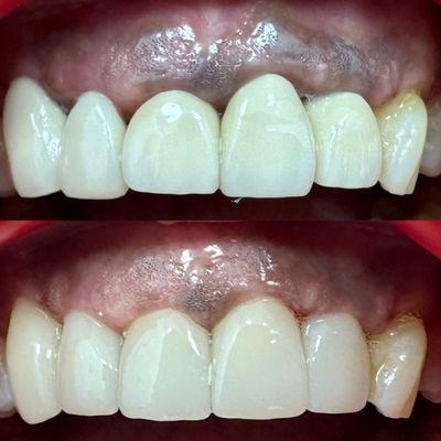 Before & After: 5 Zirconia crowns