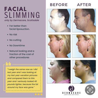 Our facial slimming procedure will make you look much lighter without losing an ounce! This is a separate protocol from the "smart Lift"