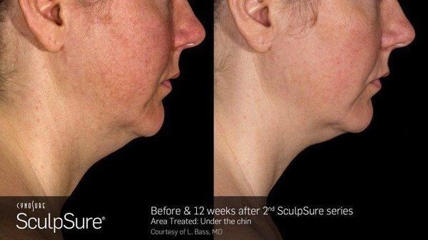 Double Chin Reduction with SculpSure Submental