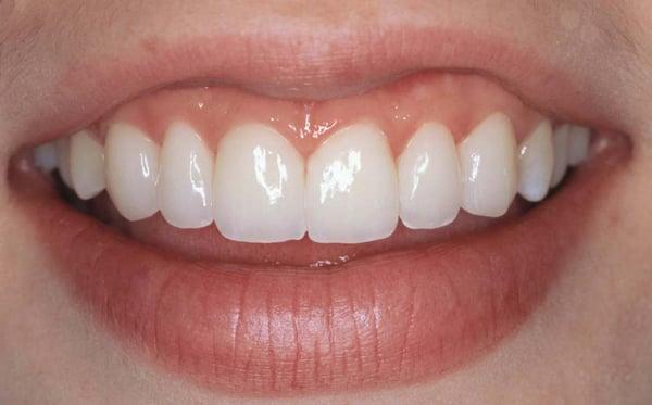 Cosmetic Dentistry To Give You A Natural And Beautiful Look