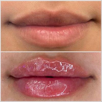 ‍: Dr. Elizabeth Vega DNP APRN FNP BC
: lip filler consultation
: 512.961.9113