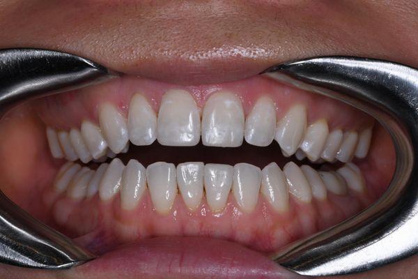 after cosmetic work on front teeth and mid-invisalign treatment