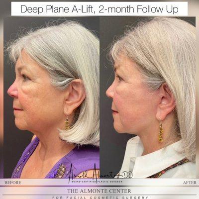 B/A: A-Lift, Dr. Almonte's signature facelift