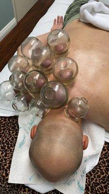 After cupping, the neck muscles and shoulder muscles relax a lot and the pain is lessened