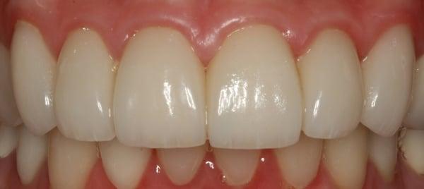 After porcelain veneers were placed.