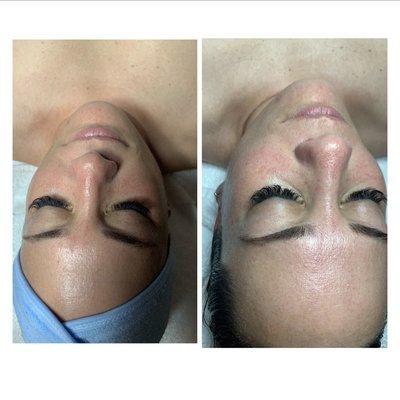 Gua sha facial before and after