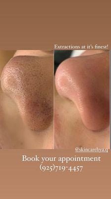 Hydra Facials results with manual extractions.