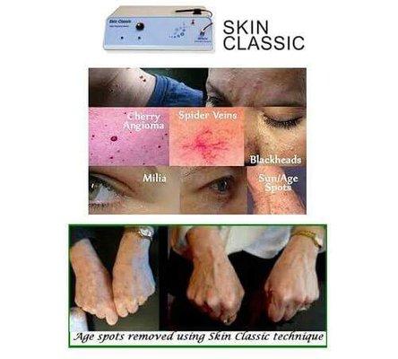 The Skin Classic Removal Machine is Amazing!! I highly recommend it.