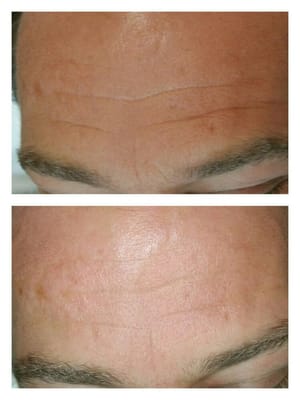 Micro Needling