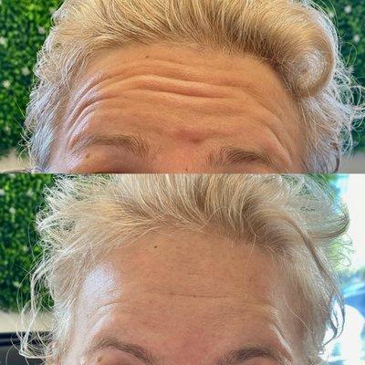 Wrinkles free #botoxtreatment #Jeuveau #daxxify #dysport #xeomin #medspa #arlingtonheights