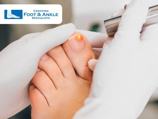 laser therapy for toenail