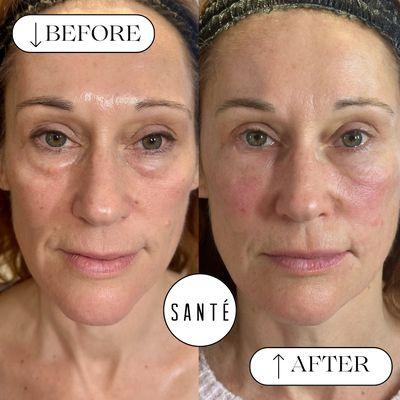 Before + After of Derma PRP to bring back volume in the face