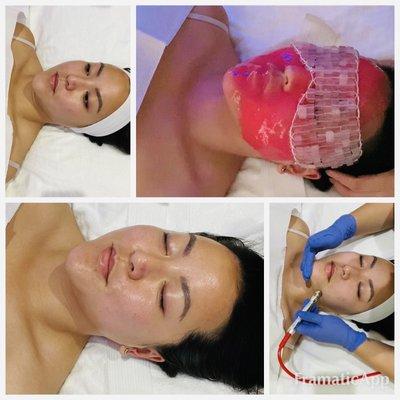 Microdermabrasion Facial.