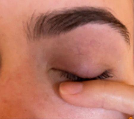 Swollen eyelid