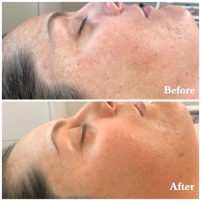 Hyperpigmentation: 5 DMK Enzyme Treatments with Full Skincare Regimen ^ months total