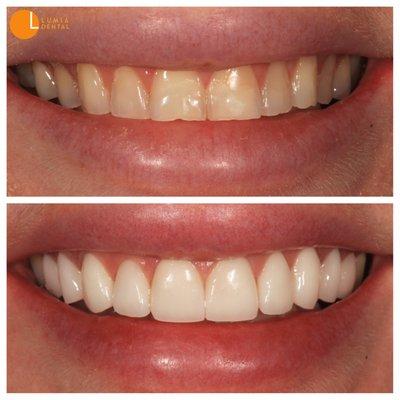 Porcelain veneers and crowns protect your teeth from further chipping, wear, and erosion, while having the ability to transform your smile.