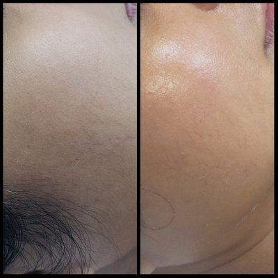 The skin after dermaplanning.Results are real with smoother,softer vibrant looking skin.